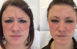 Hình ảnh tiêm Botox trước sau Dr Tâm – ca 42