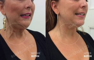 Hình ảnh tiêm Botox trị thừng cổ trước sau Dr Tâm – ca 43