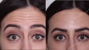 Hình ảnh tiêm Botox trước sau Dr Tâm – ca 44