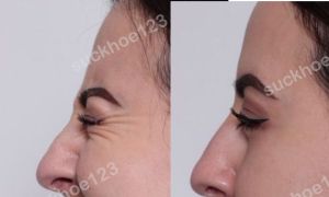 Hình ảnh tiêm Botox trước sau Dr Tâm – ca 44