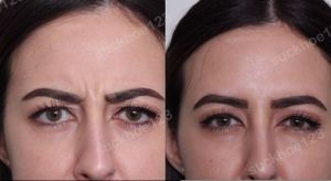 Hình ảnh tiêm Botox trước sau Dr Tâm – ca 44