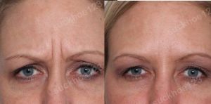 Hình ảnh tiêm Botox trước sau Dr Tâm – ca 45