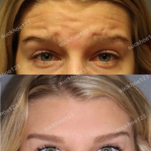 Hình ảnh tiêm Botox trước sau Dr Tâm – ca 46