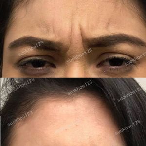 Hình ảnh tiêm Botox trước sau Dr Tâm – ca 47