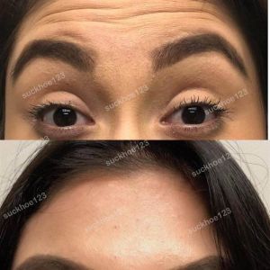 Hình ảnh tiêm Botox trước sau Dr Tâm – ca 47