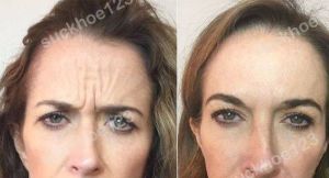 Hình ảnh tiêm Botox trước sau Dr Tâm – ca 48