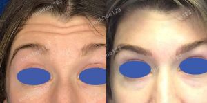 Hình ảnh tiêm Botox trước sau Dr Tâm – ca 49