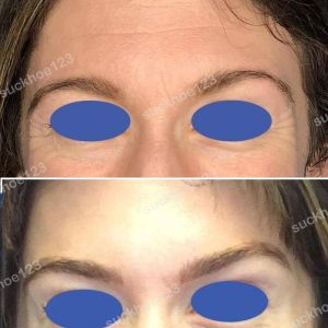 Hình ảnh tiêm Botox trước sau Dr Tâm – ca 49
