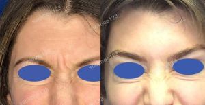 Hình ảnh tiêm Botox trước sau Dr Tâm – ca 49