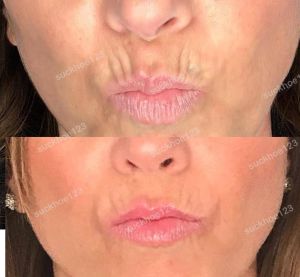 Hình ảnh tiêm Botox xóa nếp chu môi trước sau Dr Tâm – ca 51