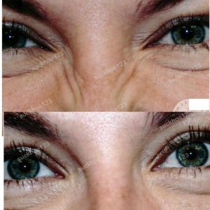 Hình ảnh tiêm Botox trị nếp nhăn trên mũi trước sau Dr Tâm – ca 52