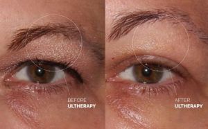 Hình ảnh Ultherapy nâng chân mày trước sau Dr Tâm - ca 46