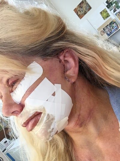 Căng da mặt và tái tạo bề mặt da bằng laser