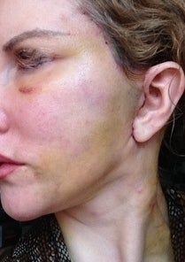 Căng da mặt sau khi phẫu thuật thẩm mỹ hỏng