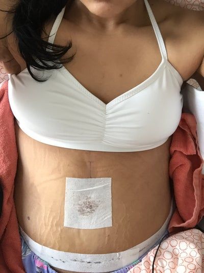 Hành trình căng da bụng với đường mổ mở rộng kết hợp hút mỡ hai bên sườn của người phụ nữ sau giảm kỷ lục 72kg