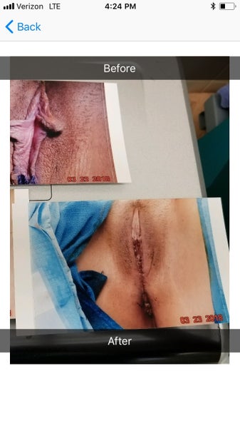 Mẹ 35 tuổi 2 con với hành trình phẫu thuật trẻ hóa âm đạo kết hợp tạo hình môi bé và chỉnh sửa đáy chậu.