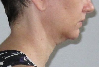 46 tuổi và đã sẵn sàng căng da mặt