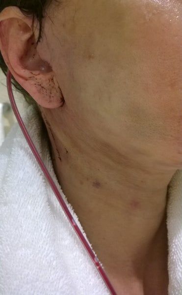 46 tuổi và đã sẵn sàng căng da mặt
