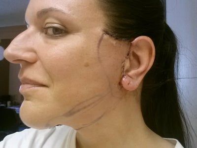 Review căng da cổ, căng da phần dưới của mặt và kết quả sau 3 năm