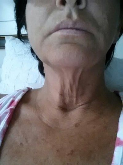 Căng da mặt sau nhiều năm tiêm filler