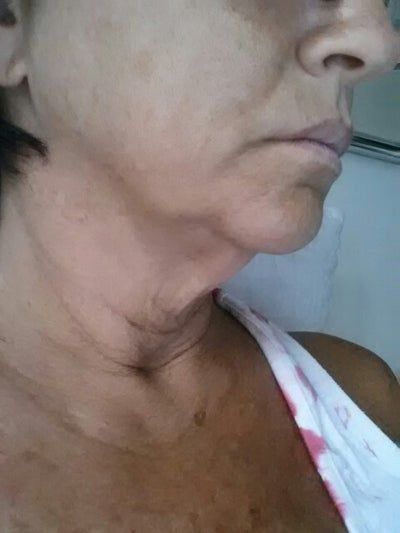 Căng da mặt sau nhiều năm tiêm filler