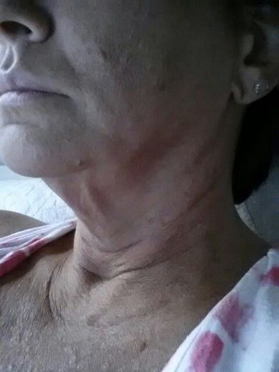 Căng da mặt sau nhiều năm tiêm filler