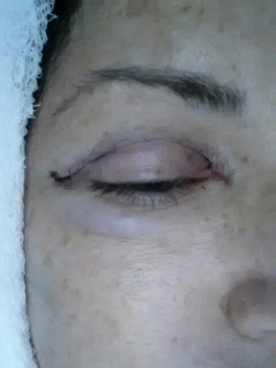 Căng da mặt sau nhiều năm tiêm filler