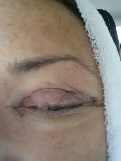 Căng da mặt sau nhiều năm tiêm filler