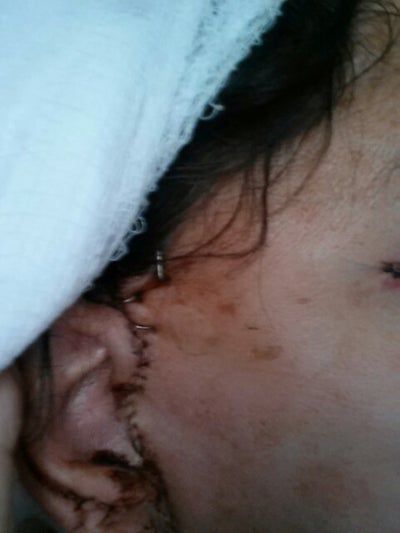 Căng da mặt sau nhiều năm tiêm filler