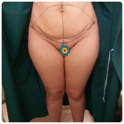 Hành trình căng da bụng “lột xác” bụng ngấn mỡ thành eo thon sau khi sinh em bé chỉ 3 tháng của người mẹ 3 con