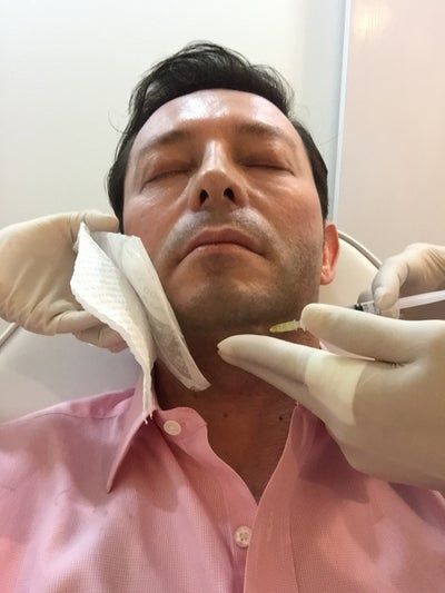 Trải nghiệm căng da mặt bằng chỉ - căng da mặt không phẫu thuật và tiêm LLD tan mỡ