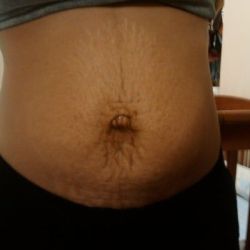 Nên tạo hình thành bụng toàn phần hay tạo hình bụng mini để làm bụng phẳng?