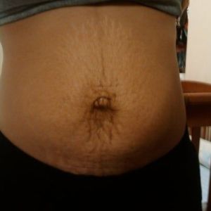 Nên tạo hình thành bụng toàn phần hay tạo hình bụng mini để làm bụng phẳng?