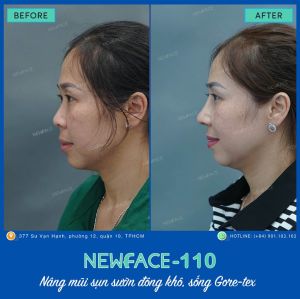 Hình ảnh nâng mũi trước sau Bs Trần Phương - Ca 110