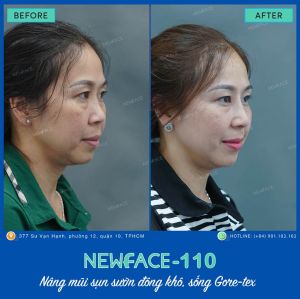 Hình ảnh nâng mũi trước sau Bs Trần Phương - Ca 110