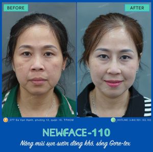 Hình ảnh nâng mũi trước sau Bs Trần Phương - Ca 110
