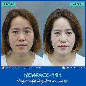 Hình ảnh nâng mũi trước sau Bs Trần Phương - Ca 111