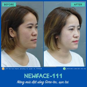 Hình ảnh nâng mũi trước sau Bs Trần Phương - Ca 111