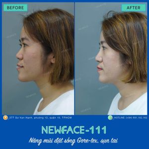 Hình ảnh nâng mũi trước sau Bs Trần Phương - Ca 111