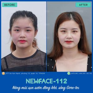 Hình ảnh nâng mũi trước sau Bs Trần Phương - Ca 112