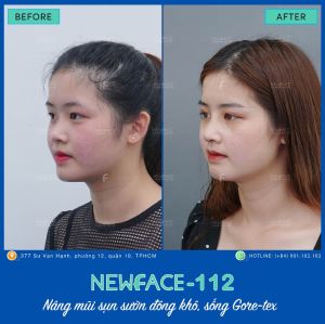 Hình ảnh nâng mũi trước sau Bs Trần Phương - Ca 112