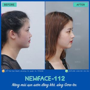 Hình ảnh nâng mũi trước sau Bs Trần Phương - Ca 112