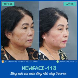 Hình ảnh nâng mũi trước sau Bs Trần Phương - Ca 113