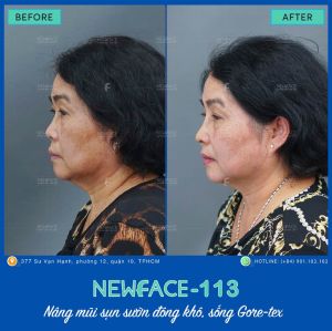 Hình ảnh nâng mũi trước sau Bs Trần Phương - Ca 113