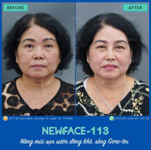 Hình ảnh nâng mũi trước sau Bs Trần Phương - Ca 113