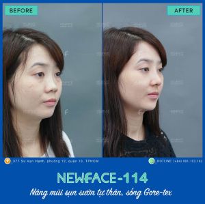 Hình ảnh nâng mũi trước sau Bs Trần Phương - Ca 114