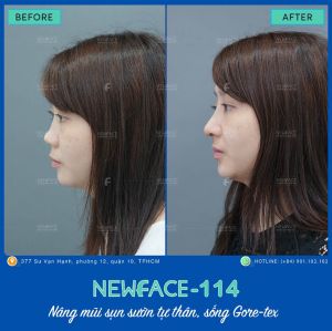 Hình ảnh nâng mũi trước sau Bs Trần Phương - Ca 114