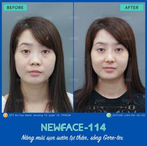 Hình ảnh nâng mũi trước sau Bs Trần Phương - Ca 114