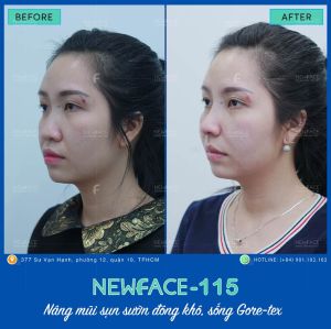 Hình ảnh nâng mũi trước sau Bs Trần Phương - Ca 115