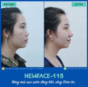 Hình ảnh nâng mũi trước sau Bs Trần Phương - Ca 115